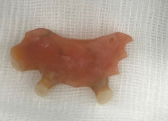 Bị hóc, nuốt cả cung răng giả vào thực quản