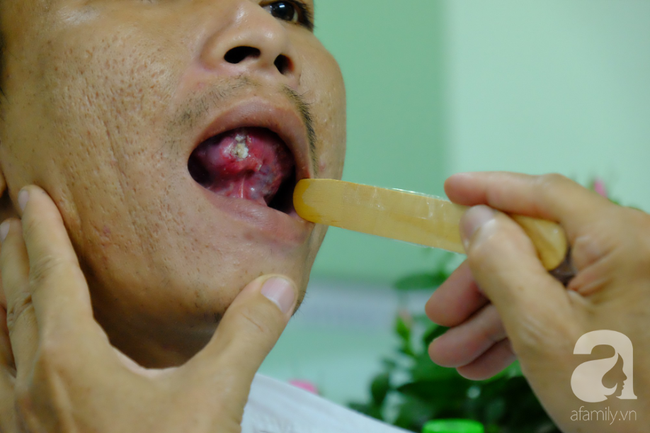 Từ 1 vết loét nhỏ trong miệng, chàng trai 19 tuổi bàng hoàng khi biết mình là bệnh nhân trẻ nhất bị ung thư lưỡi