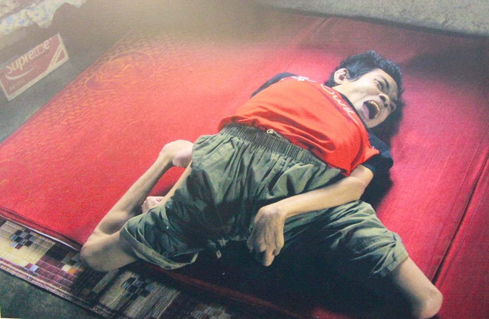 Nỗi đau da cam di truyền qua bốn thế hệ người Việt