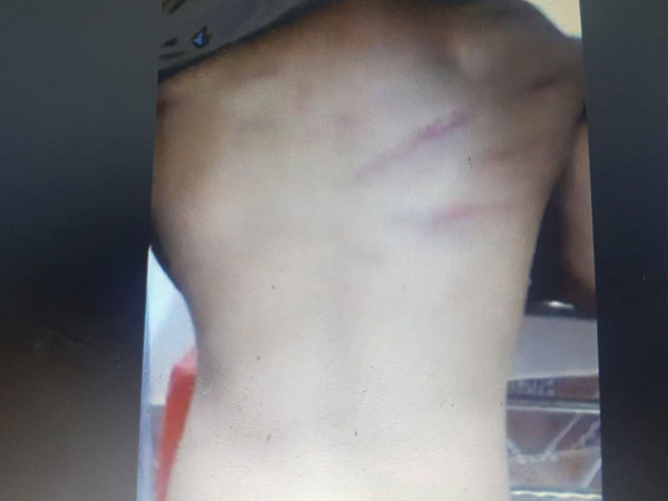 Lười ghi chép bài, học sinh lớp 1 bị cô giáo dùng que đánh bầm lưng