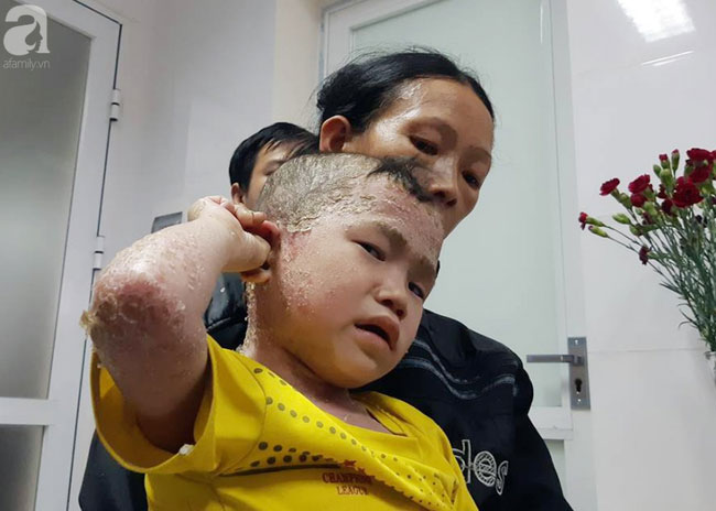 10 ngày thay đổi kỳ diệu của cậu bé người cóc chốn rừng núi xuống Hà Nội chữa bệnh