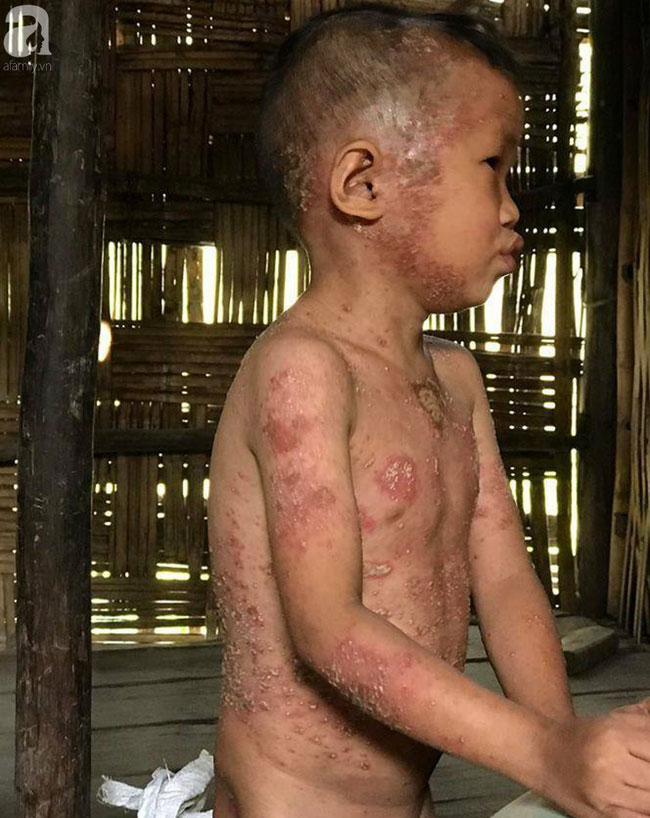 10 ngày thay đổi kỳ diệu của cậu bé người cóc chốn rừng núi xuống Hà Nội chữa bệnh