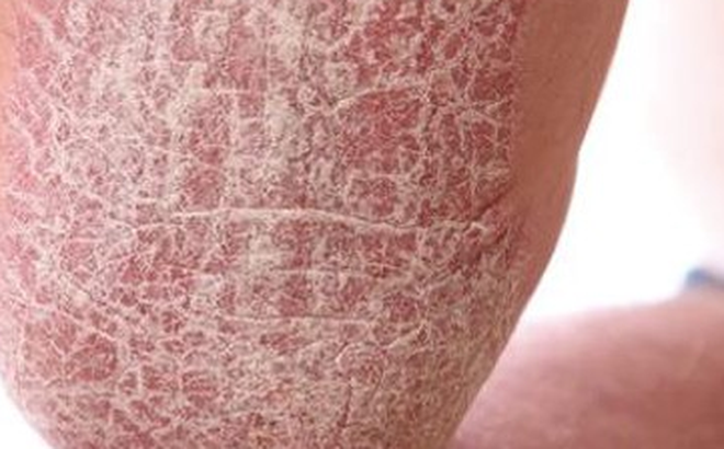 Hàng triệu người Việt mắc căn bệnh lạ xù xì như cóc, nhiều người tuyệt vọng vì bị kỳ thị