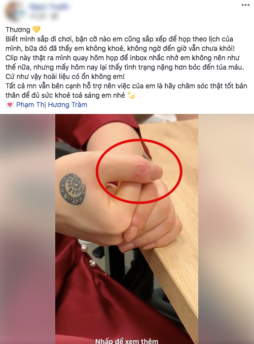 Hương Tràm liên tục mất ngủ, stress đến mức tự bóc tay rỉ máu khiến người hâm mộ lo lắng
