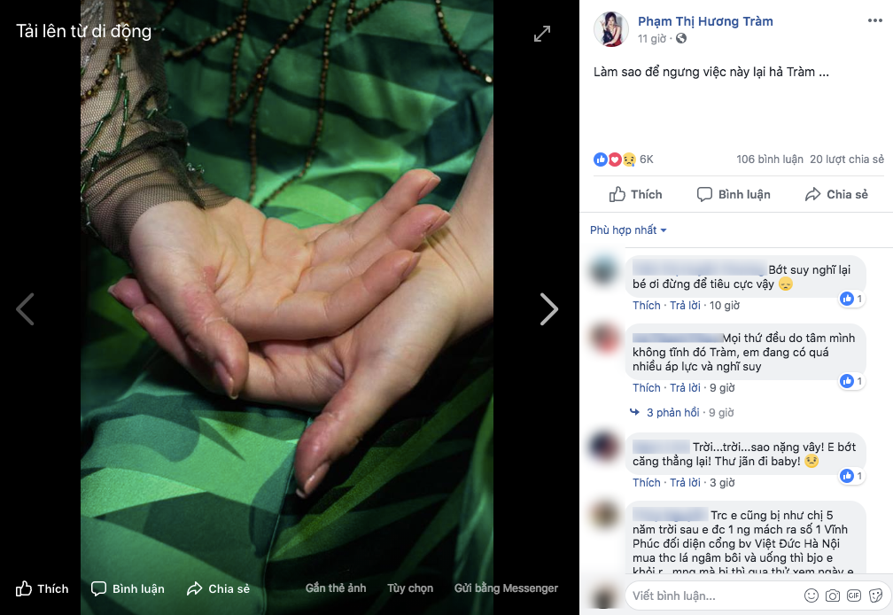 Hương Tràm liên tục mất ngủ, stress đến mức tự bóc tay rỉ máu khiến người hâm mộ lo lắng