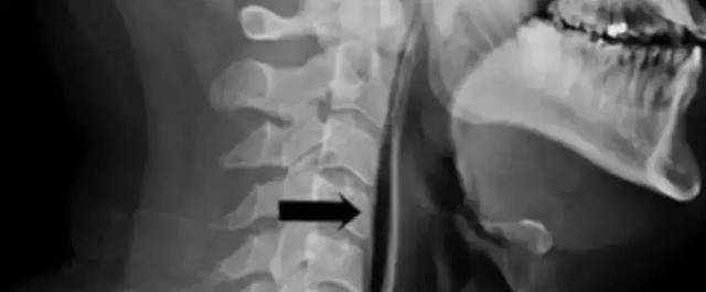 Người đàn ông 34 tuổi nhịn hắt hơi dẫn đến vỡ… cổ họng