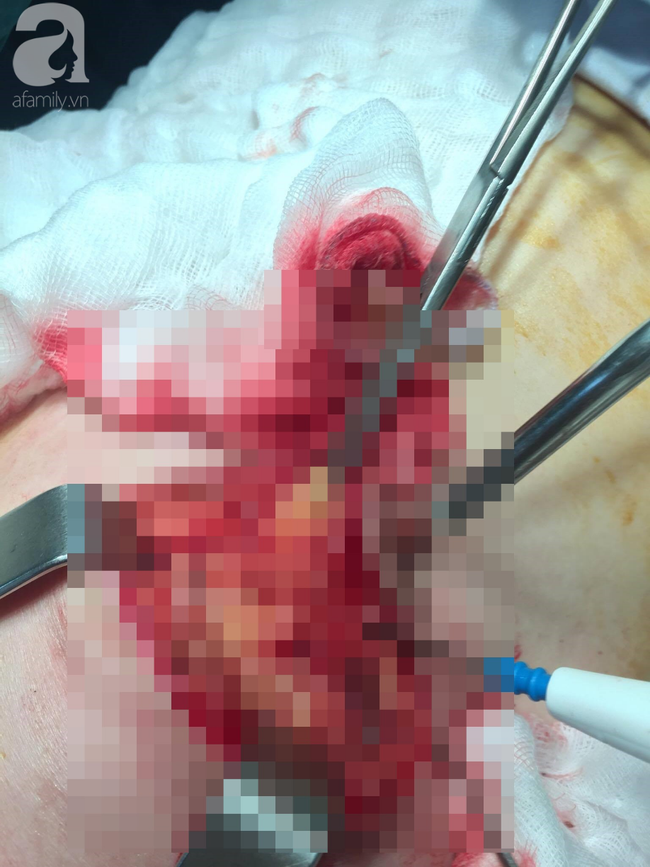 Từ vụ em gái kết nghĩa Quách Tuấn Du bị vỡ túi ngực: Nâng ngực thế nào mới an toàn?