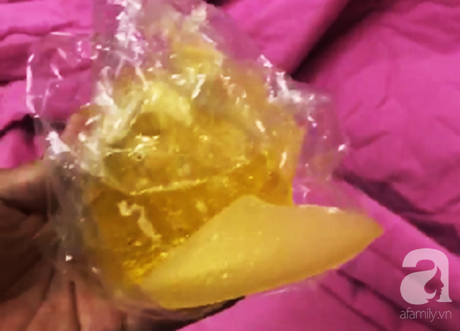 Từ vụ em gái kết nghĩa Quách Tuấn Du bị vỡ túi ngực: Nâng ngực thế nào mới an toàn?