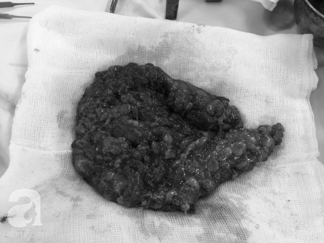 Từ vụ em gái kết nghĩa Quách Tuấn Du bị vỡ túi ngực: Nâng ngực thế nào mới an toàn?