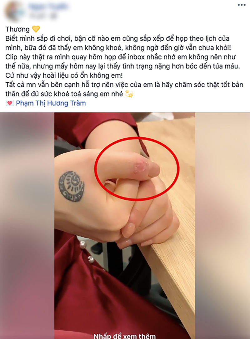 Sao Việt ngược đãi bản thân vì stress: Tự bóc tay đến rỉ máu, thường xuyên nghĩ đến việc tự tử