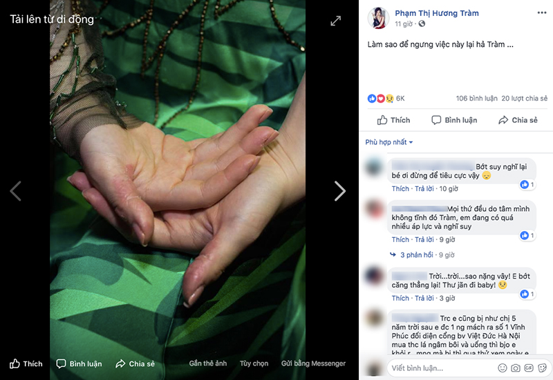 Sao Việt ngược đãi bản thân vì stress: Tự bóc tay đến rỉ máu, thường xuyên nghĩ đến việc tự tử