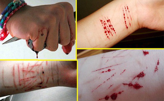 Hương Tràm stress tự bóc tay rỉ máu: Bác sĩ cảnh báo Hội chứng nguy hiểm gây chết người