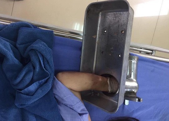 Máy xay thịt nuốt trọn bàn tay, nạn nhân vác máy đến cầu cứu bác sĩ