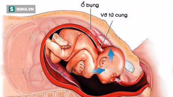 Sản phụ Hà Nội vỡ tử cung suýt tử vong: Chuyên gia khuyến cáo tai biến sản khoa nguy hiểm