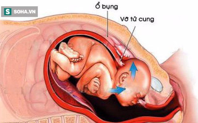 Sản phụ Hà Nội vỡ tử cung suýt tử vong: Chuyên gia khuyến cáo tai biến sản khoa nguy hiểm