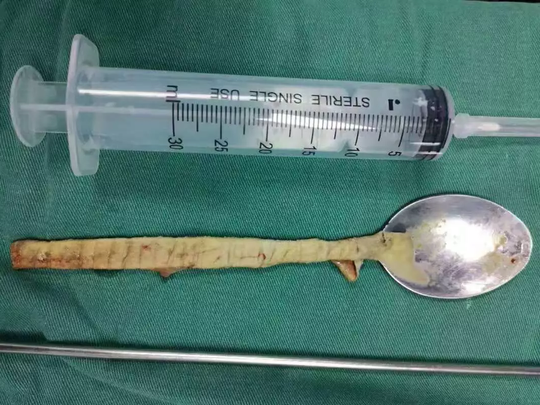 Muỗng dài 20 cm kẹt trong cổ họng 1 năm mới đi bác sĩ