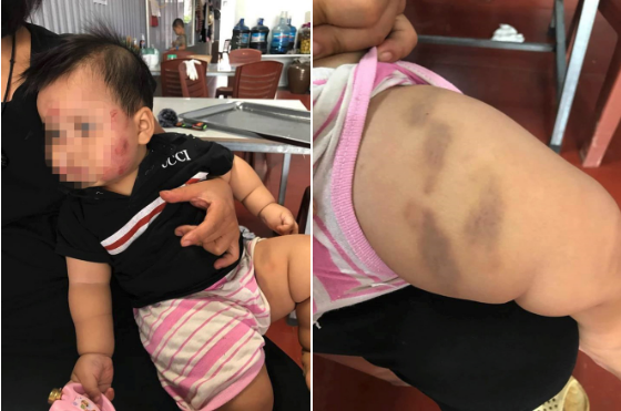 Phụ huynh tố trẻ 11 tháng tuổi bị cắn khắp mặt