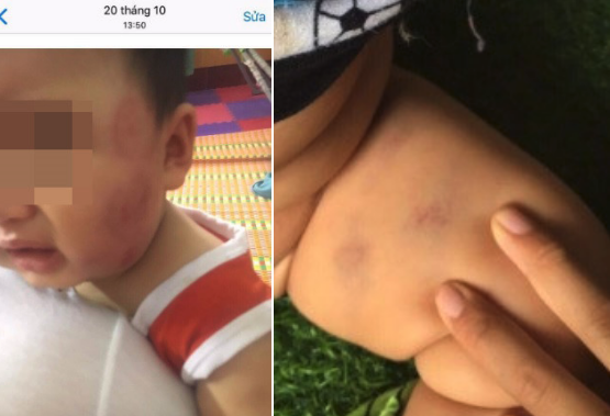 Phụ huynh tố trẻ 11 tháng tuổi bị cắn khắp mặt
