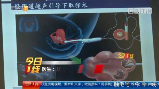 Sự thật đáng sợ phía sau dịch vụ mua bán trứng của các cô gái trẻ