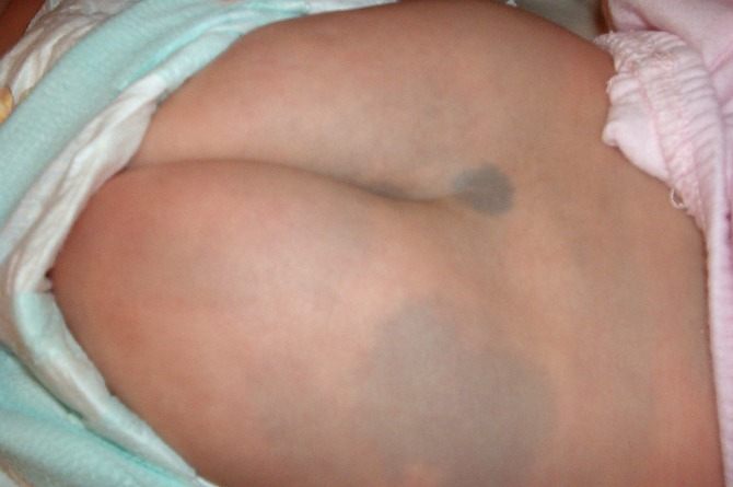 Trẻ bị chàm xanh: Những điều cha mẹ cần biết