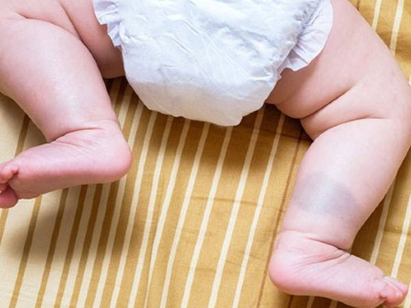 Trẻ bị chàm xanh: Những điều cha mẹ cần biết