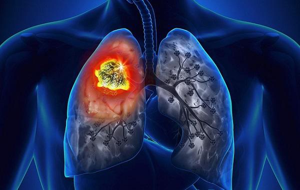 Thiếu niên 16 tuổi mắc ung thư, nguyên nhân là do thói quen hàng ngày của ông và bố