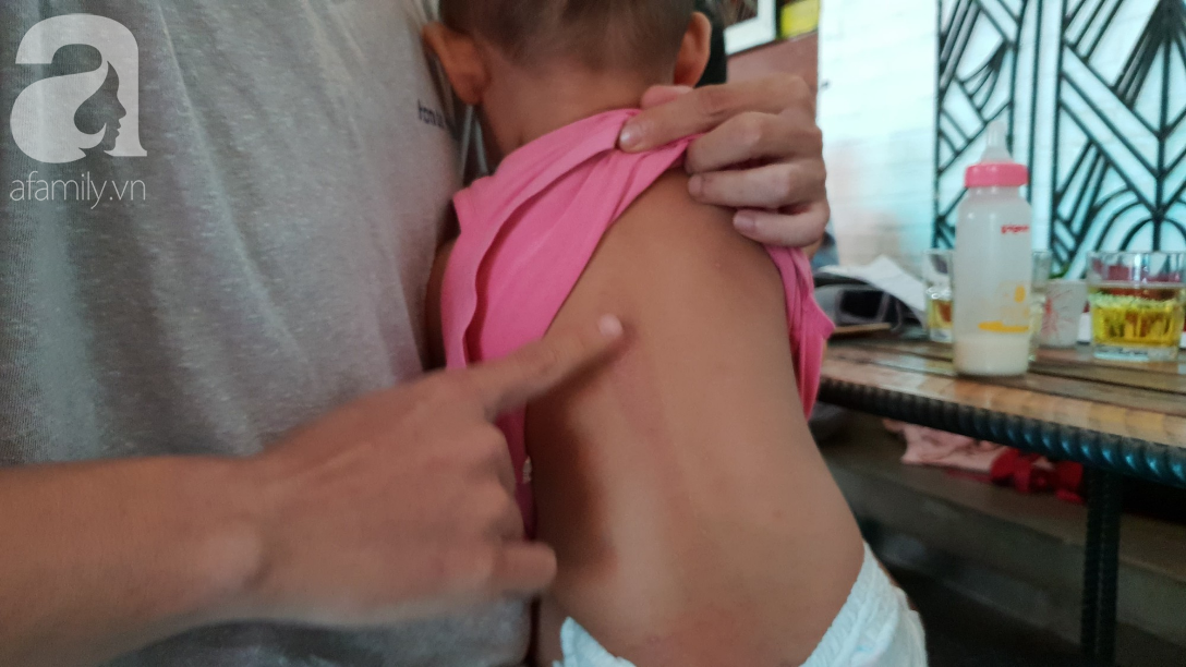 Mẹ bé gái 18 tháng tuổi nghi bị cô giáo tạt nước sôi gây phỏng chân: Đêm nào con bé cũng giật mình khóc ngất