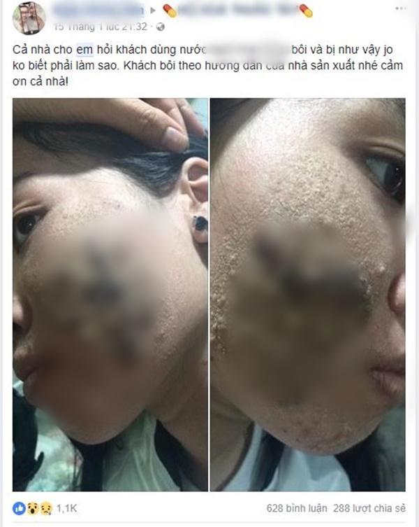 SỐC: Cô gái tưới cồn bật lửa xông da bị luộc chín mặt, da tróc thành mảng khó cứu vãn SỐC: Cô gái tưới cồn bật lửa xông da bị luộc chín mặt, da tróc thành mảng khó cứu vãn