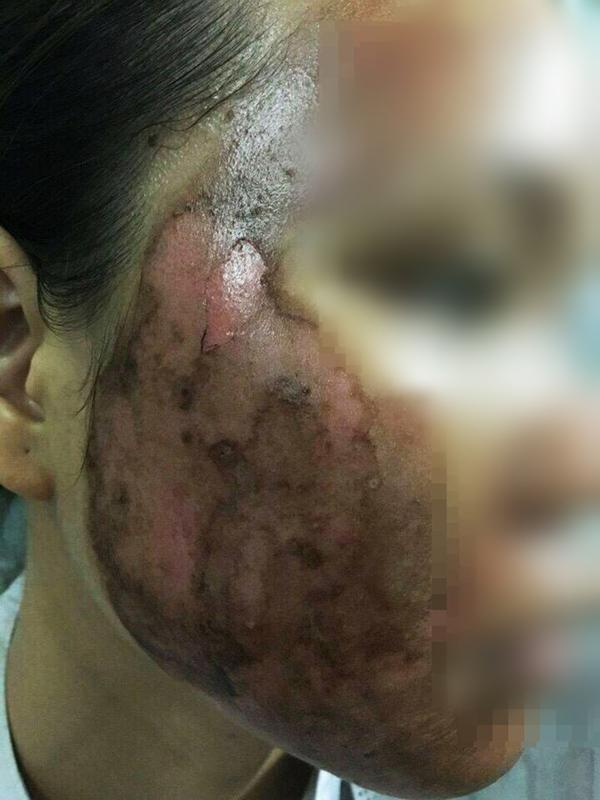 SỐC: Cô gái tưới cồn bật lửa xông da bị luộc chín mặt, da tróc thành mảng khó cứu vãn SỐC: Cô gái tưới cồn bật lửa xông da bị luộc chín mặt, da tróc thành mảng khó cứu vãn