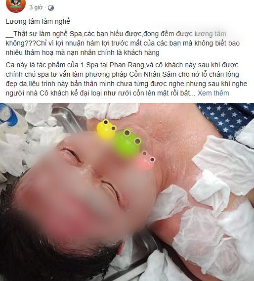 SỐC: Cô gái tưới cồn bật lửa xông da bị luộc chín mặt, da tróc thành mảng khó cứu vãn SỐC: Cô gái tưới cồn bật lửa xông da bị luộc chín mặt, da tróc thành mảng khó cứu vãn