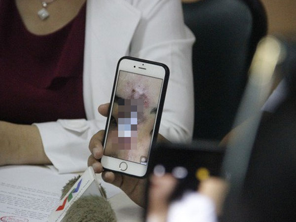 Tiêm chất làm đầy mũi, nữ sinh viên ở Sài Gòn đau đớn vì bị nhiễm trùng hoại tử