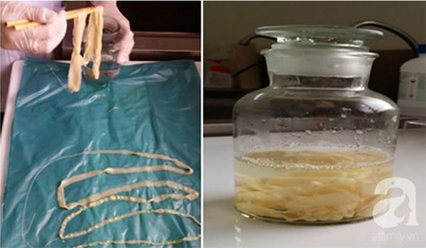 Đâu chỉ do ăn phải thịt lợn gạo, những kiểu ăn uống này cũng dễ khiến bạn bị cả búi sán làm tổ trong người!