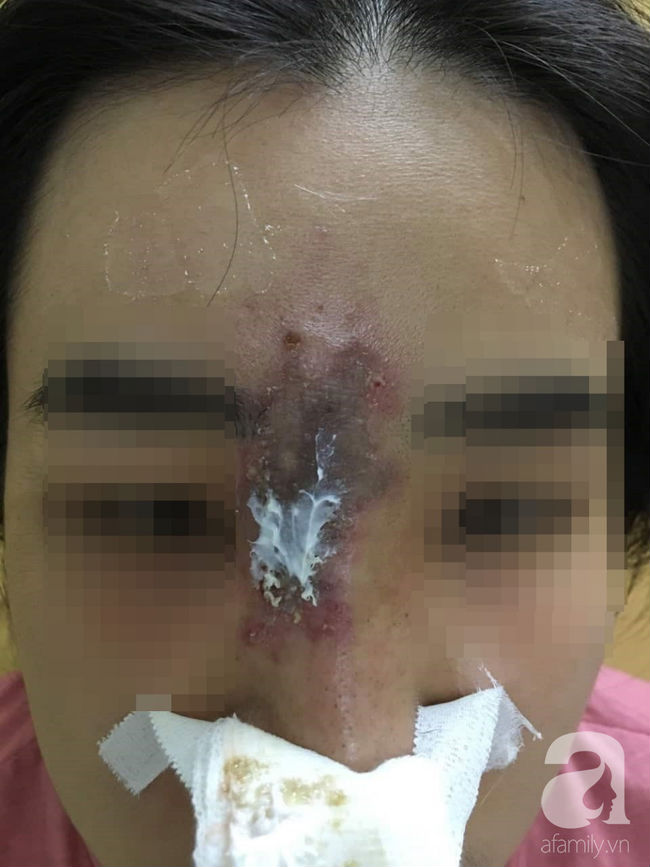 Nữ sinh viên 19 tuổi biến dạng mặt, suýt mù mắt vì tiêm nâng mũi tại thẩm mỹ viện chung cư Nữ sinh viên 19 tuổi biến dạng mặt, suýt mù mắt vì tiêm nâng mũi tại thẩm mỹ viện chung cư