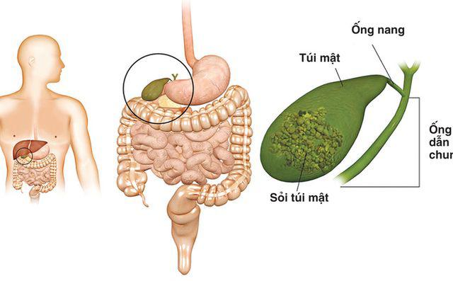 Túi mật của người phụ nữ chứa đầy sỏi, chỉ vì cô uống thứ này liên tục trong 20 năm Túi mật của người phụ nữ chứa đầy sỏi, chỉ vì cô uống thứ này liên tục trong 20 năm
