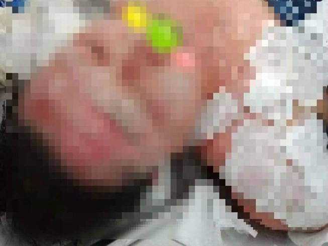 Sự thật về người phụ nữ bỏng nặng do làm đẹp bằng cồn nhân sâm