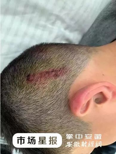 Đi trễ 2 phút, cậu bé bị giáo viên đánh bằng 4 cây chổi, nhìn ảnh thương tích cư dân mạng tức giận phán không phải con người