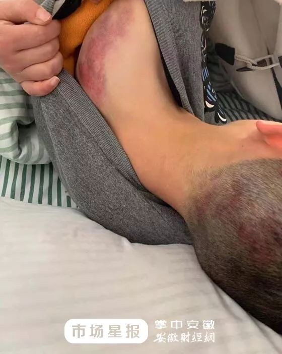 Đi trễ 2 phút, cậu bé bị giáo viên đánh bằng 4 cây chổi, nhìn ảnh thương tích cư dân mạng tức giận phán không phải con người