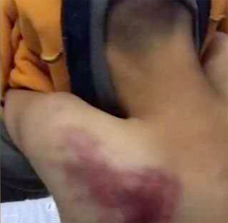 Đi trễ 2 phút, cậu bé bị giáo viên đánh bằng 4 cây chổi, nhìn ảnh thương tích cư dân mạng tức giận phán không phải con người