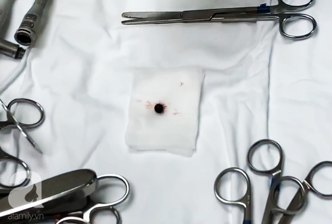 Đang đứng trước cửa nhà, người phụ nữ 32 tuổi bị viên đạn ghim thẳng vào mắt, suýt mù vĩnh viễn