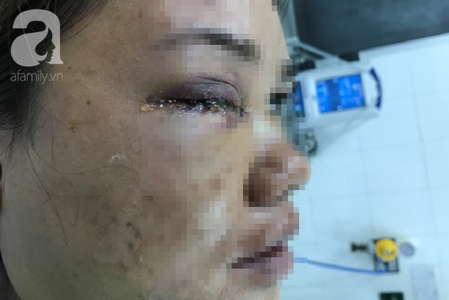 Đang đứng trước cửa nhà, người phụ nữ 32 tuổi bị viên đạn ghim thẳng vào mắt, suýt mù vĩnh viễn