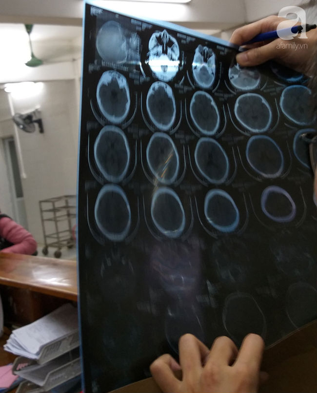 Hà Nội: Nữ sinh lớp 9 tố bị vợ hai của bố đập đầu, đánh tới mức phải nhập viện