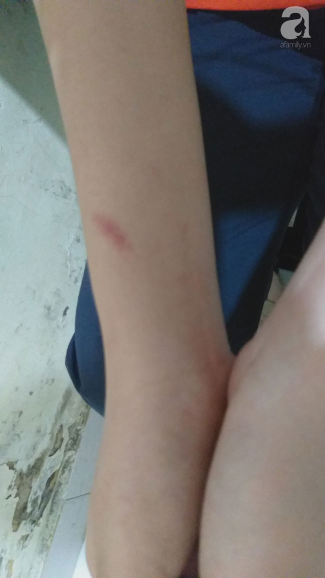 Hà Nội: Nữ sinh lớp 9 tố bị vợ hai của bố đập đầu, đánh tới mức phải nhập viện