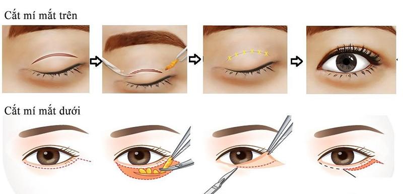 Nhìn những hình ảnh kinh hoàng này, chị em có cân nhắc lại về quyết định cắt mí mắt không?