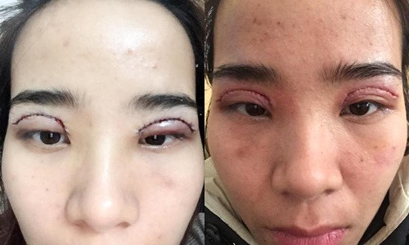 Nhìn những hình ảnh kinh hoàng này, chị em có cân nhắc lại về quyết định cắt mí mắt không?