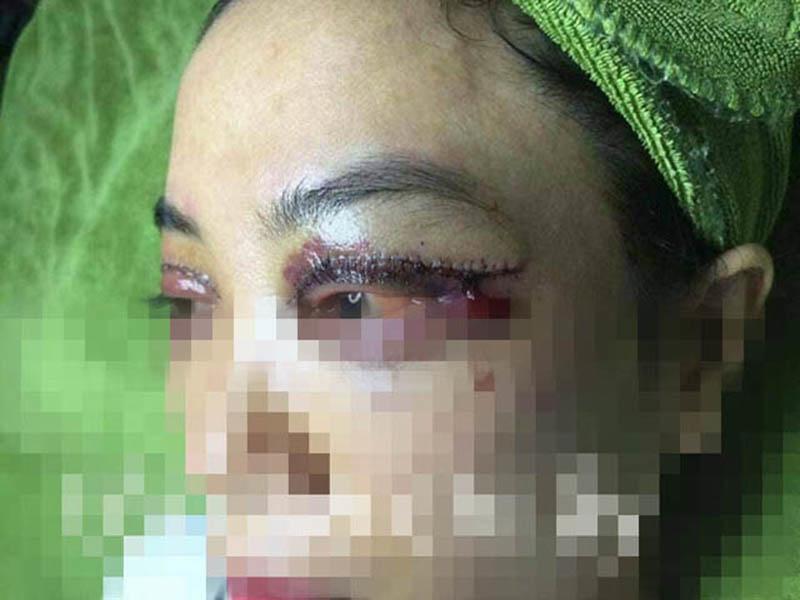 Nhìn những hình ảnh kinh hoàng này, chị em có cân nhắc lại về quyết định cắt mí mắt không?