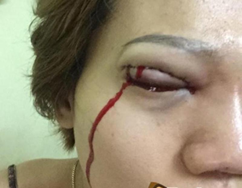 Nhìn những hình ảnh kinh hoàng này, chị em có cân nhắc lại về quyết định cắt mí mắt không?