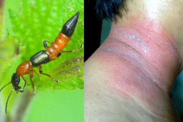 Hàng chục người nhập viện vì kiến ba khoang tấn công, ngay bây giờ cần lập tức làm những điều này