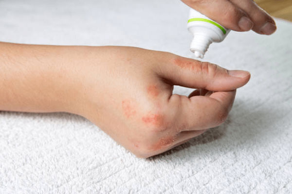 Hàng chục người nhập viện vì kiến ba khoang tấn công, ngay bây giờ cần lập tức làm những điều này