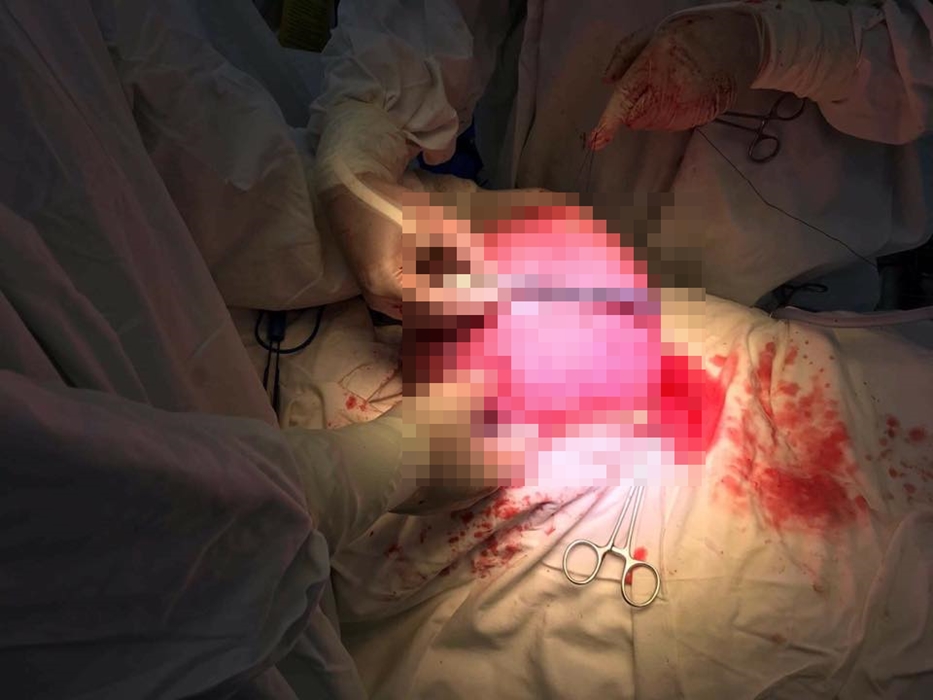 Người phụ nữ có khối u xơ tử cung nặng bằng bé 9 tháng tuổi