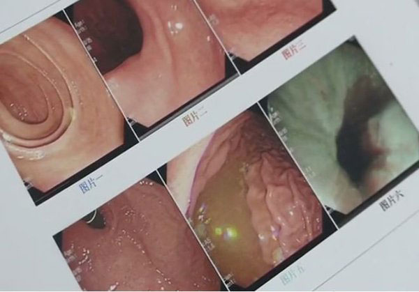 Cảnh báo chảy máu dạ dày bởi món ăn vặt phổ biến mùa lạnh